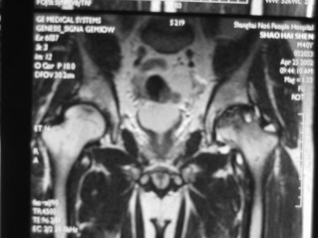 早期股骨头坏死核磁共振能看到吗,股骨头坏死修复过程的磁共振表现