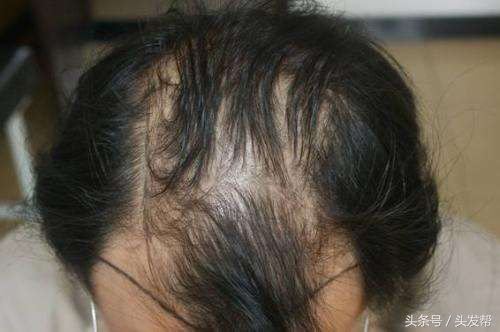 脱发到底都是什么原因,都有哪些原因?你又中招了吗?