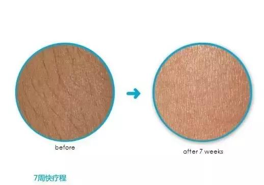 入夏前脱毛,最好用的脱毛小技巧是什么