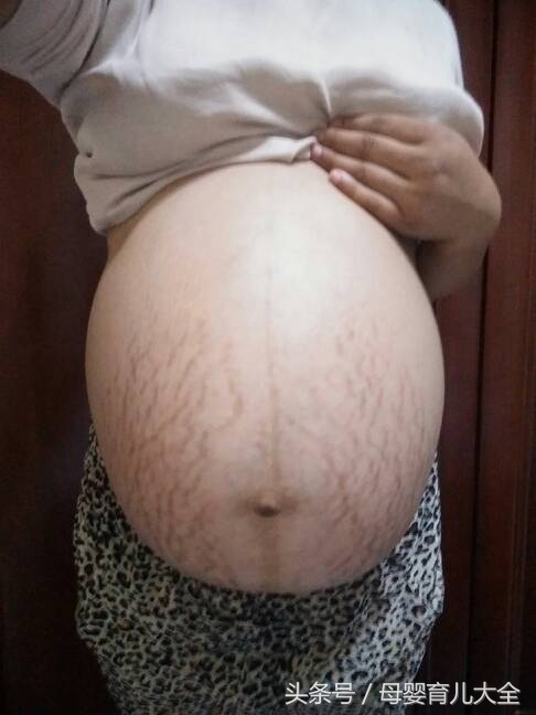 怀孕后有妊娠纹,怀孕几个月会长妊娠纹