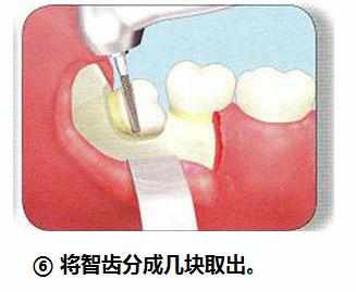 智齿横着长没露出来,智齿牙横着长怎么办