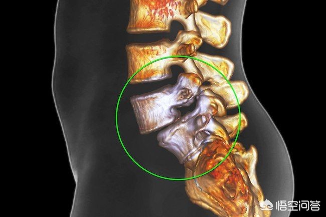 腰疼做燕飞操怎么做,腰疼做小燕飞的姿势可以么
