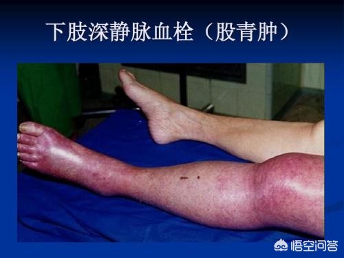 骨折手术后有点隐隐的疼正常吗,骨折手术后下肢血栓怎么办