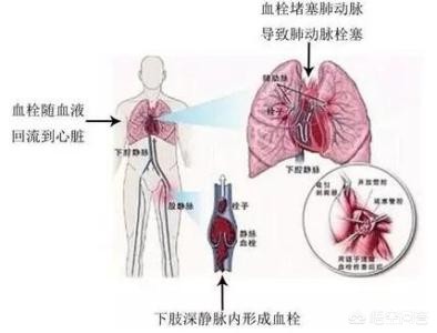 骨折手术后有点隐隐的疼正常吗,骨折手术后下肢血栓怎么办
