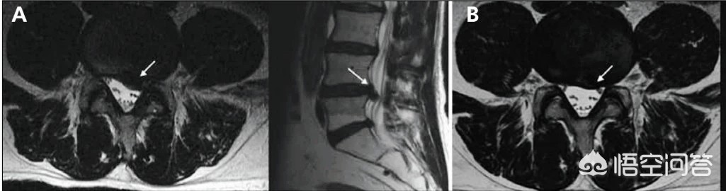 腰疼做燕飞操怎么做,腰疼做小燕飞的姿势可以么