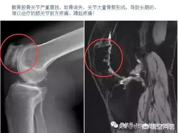 膝关节痛上下楼梯痛教你一招缓解,走平路时膝关节疼痛是什么原因