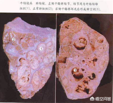 结核通俗讲什么意思,结核概述