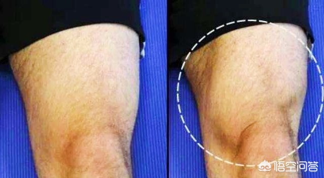 膝关节痛上下楼梯痛教你一招缓解,走平路时膝关节疼痛是什么原因