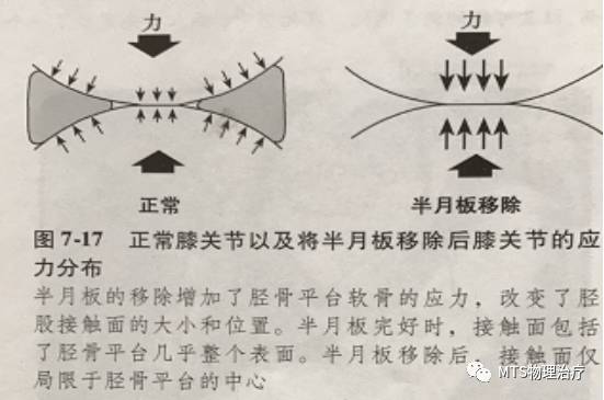 半月板撕裂,半月板资料