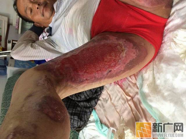 彝族村民李增贵烤贾酒盼脱贫遇火灾,栽多少包谷才能抚平49%烧伤