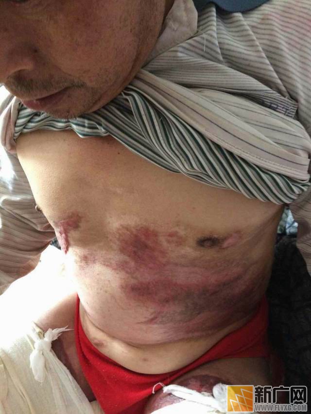 彝族村民李增贵烤贾酒盼脱贫遇火灾,栽多少包谷才能抚平49%烧伤