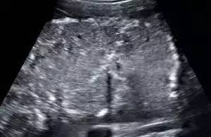 胎盘附着点位置异常,如何判断胎盘有没有剥落