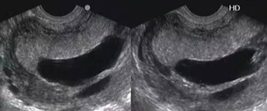 胎盘附着点位置异常,如何判断胎盘有没有剥落