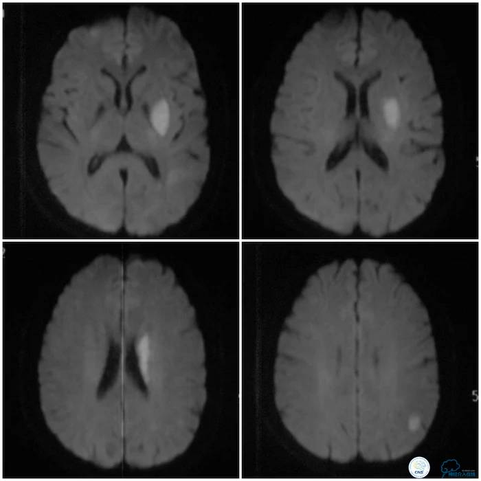 天坛医院脑梗支架,天坛医院做脑基底动脉支架