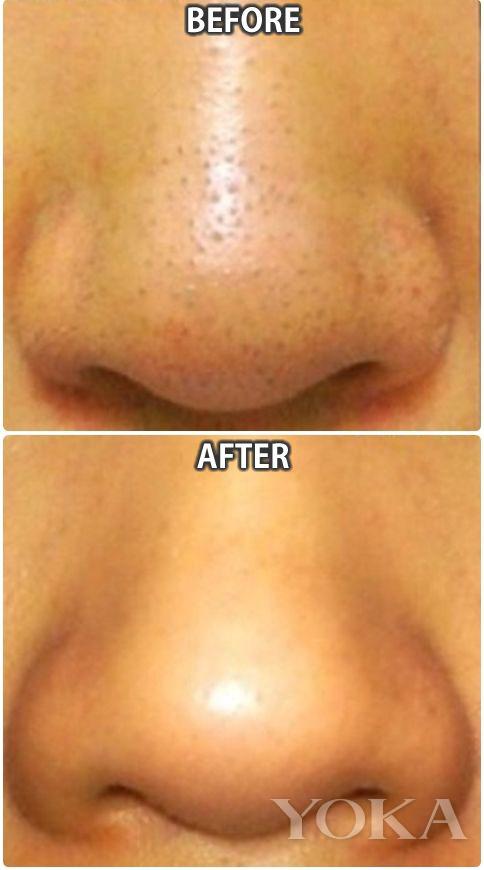 青春期去深层黑头,女生有黑头的正确消除方法