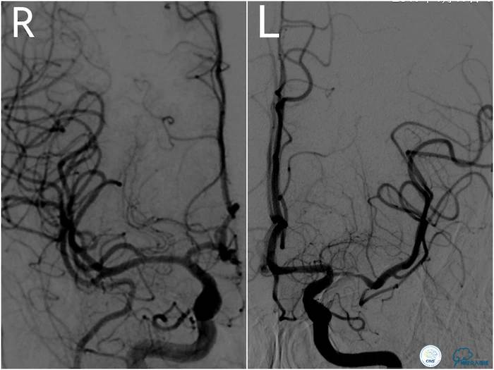 天坛医院脑梗支架,天坛医院做脑基底动脉支架