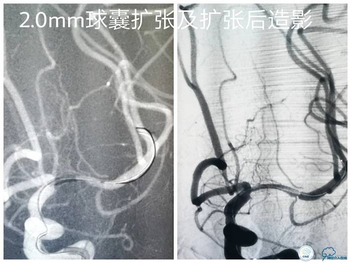 天坛医院脑梗支架,天坛医院做脑基底动脉支架