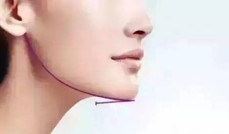 如何拥有一个好看的下巴,怎样拥有方下巴