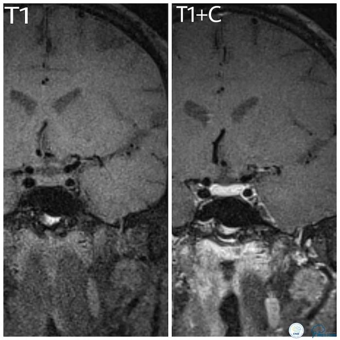 天坛医院脑梗支架,天坛医院做脑基底动脉支架