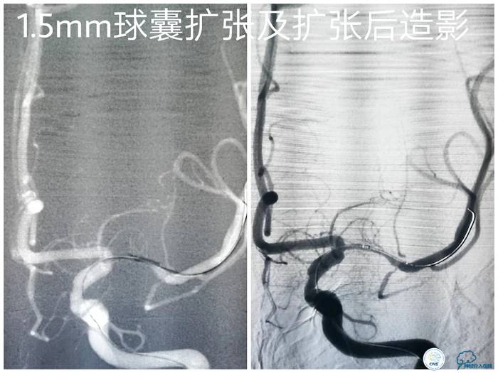 天坛医院脑梗支架,天坛医院做脑基底动脉支架