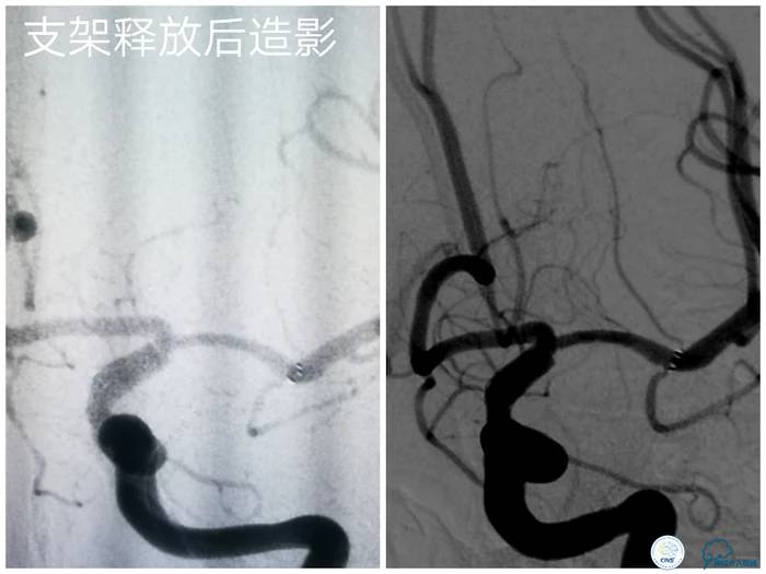 天坛医院脑梗支架,天坛医院做脑基底动脉支架