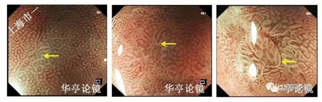 胃小灶癌变,胃体小凹型腺瘤