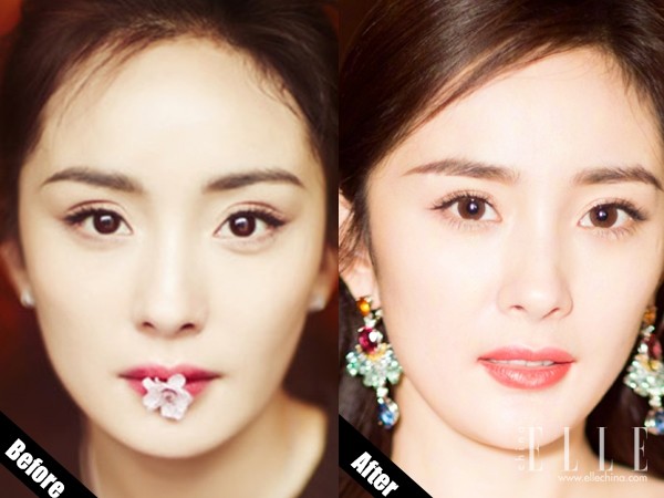 双眼皮100种整形图解,双眼皮整形全程讲解