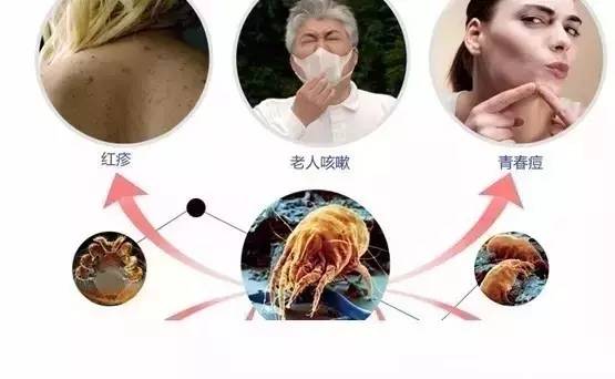 小一点的螨虫怎么消除,小螨虫最怕什么药