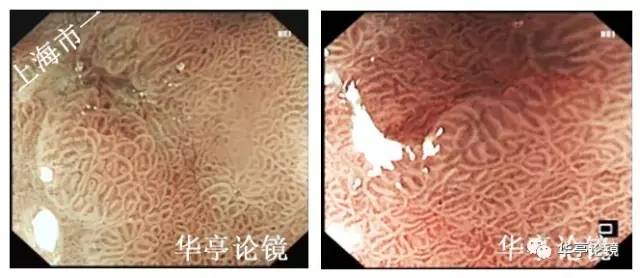 胃小灶癌变,胃体小凹型腺瘤