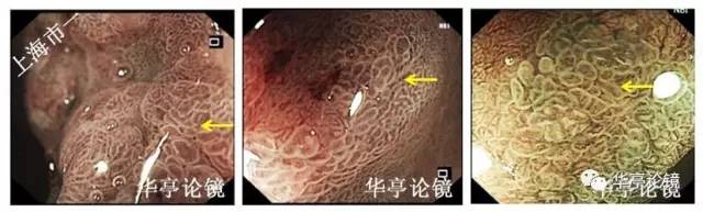 胃小灶癌变,胃体小凹型腺瘤