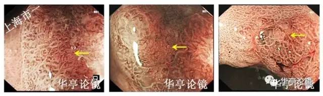 胃小灶癌变,胃体小凹型腺瘤