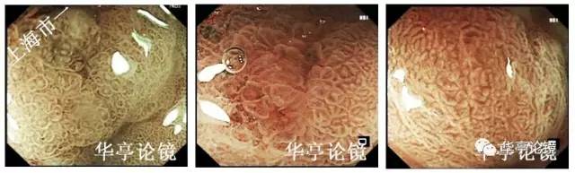 胃小灶癌变,胃体小凹型腺瘤