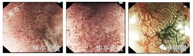 胃小灶癌变,胃体小凹型腺瘤