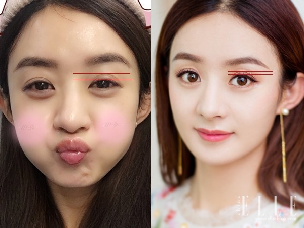 双眼皮100种整形图解,双眼皮整形全程讲解