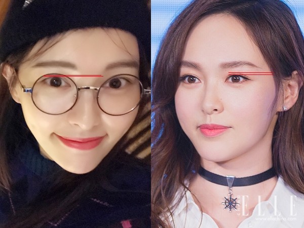 双眼皮100种整形图解,双眼皮整形全程讲解