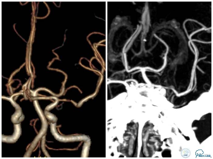 天坛医院脑梗支架,天坛医院做脑基底动脉支架