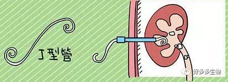 肾积水——尿都堵了，肾怎么能好