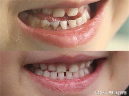 儿童乳牙有蛀牙该怎么处理才好,孩子乳牙有蛀牙该怎么处理