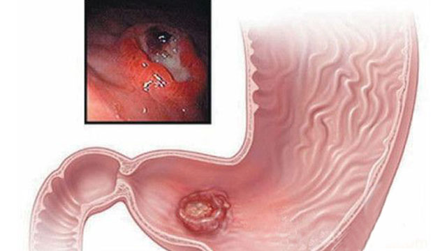 胃溃疡应该吃哪种米养胃 (胃炎胃溃疡吃粗粮好吗)