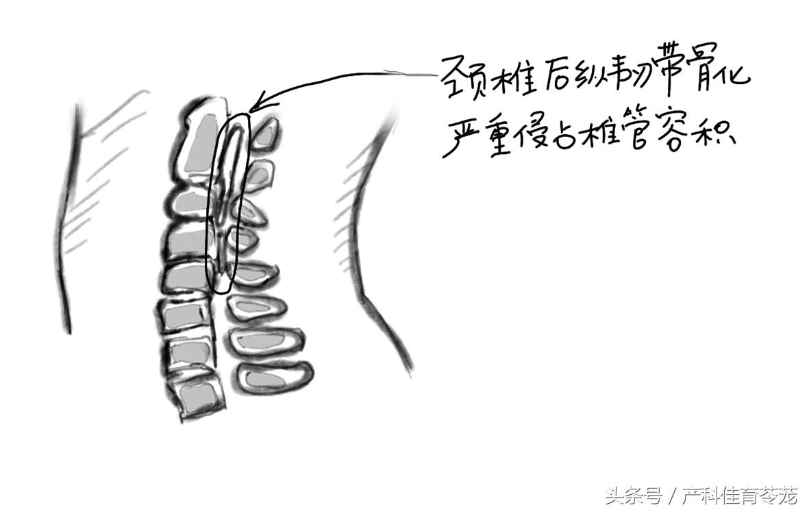 摔了一下颈椎,摔了一下颈椎和肩胛骨
