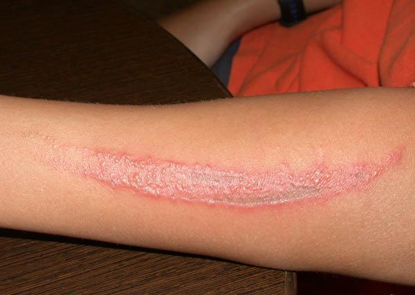 夏天来了家里的虫子好多怎么办,夏天要来了小心蚊虫