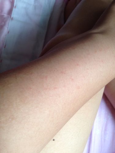 胳膊发冷是什么病？