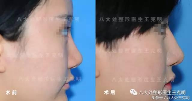 鼻整形后出现肿胀、假体外露歪斜、皮肤异样该怎么办？