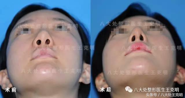 鼻整形后出现肿胀、假体外露歪斜、皮肤异样该怎么办？