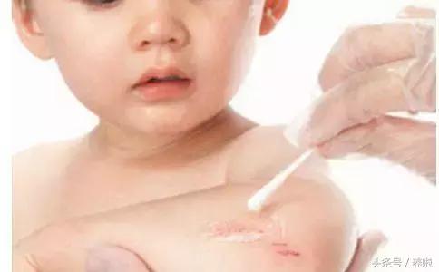 宝宝磕碰容易淤青怎么回事,宝宝磕碰肿淤青怎么处理