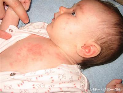 宝宝湿疹与室内湿度有关系吗,宝宝湿疹是太潮湿引起的吗