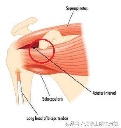 零基础练三角肌疼痛,肩关节三角肌疼痛怎么康复