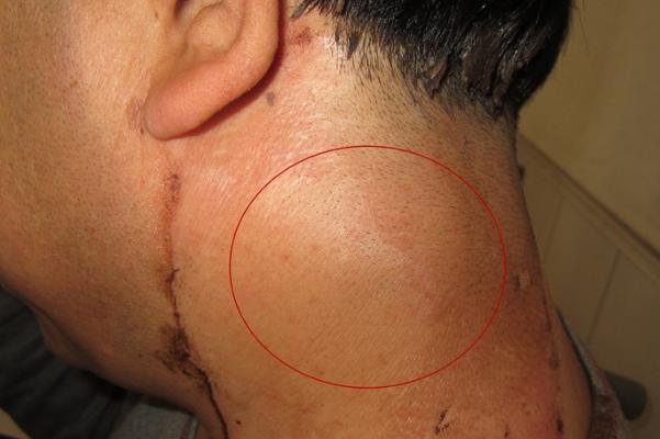 脖子淋巴结核是怎么回事,脖子上淋巴肿瘤是怎么回事