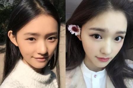 全切双眼皮增生不对称变丑,割完双眼皮为啥会变内双