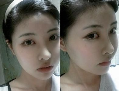 全切双眼皮增生不对称变丑,割完双眼皮为啥会变内双